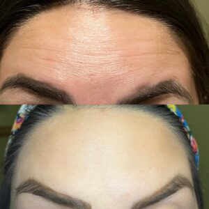 Smooth Forehead from Botox Injections - Before and After