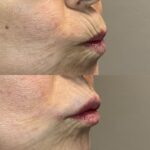 Before and After Lip Lines Reduction from Filler