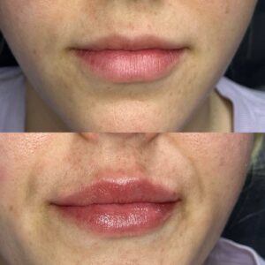 Plump Lips from Dermal Fillers
