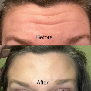 Before and After Botox on Forehead