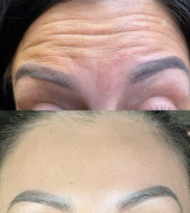 Before and After Botox